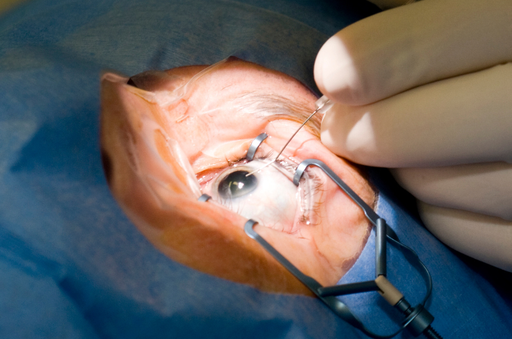 cataract surgery