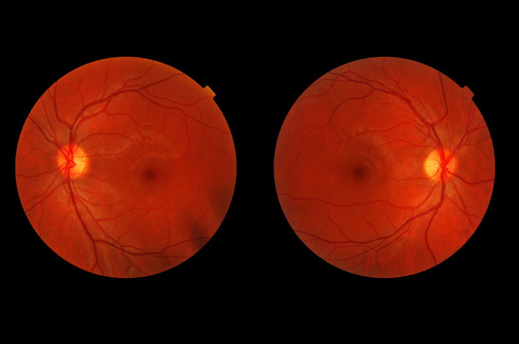 diabetic retinopathy.png