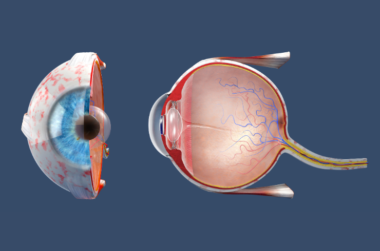 keratoconus.png
